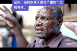 世卫:多国发现猴痘属非典型（猴痘中国有多少人感染了）