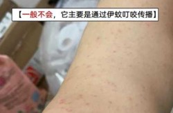登革热会传染给家人吗，登革热能人传人吗