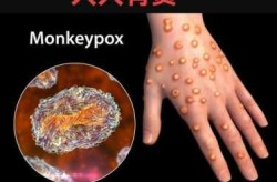 美国出现第三例猴痘死亡病例（4例死亡病例）