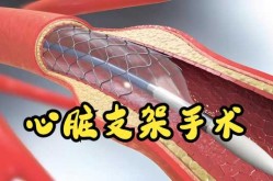 心脏支架从1.3万降至700元（2025年心脏支架新政策）