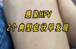 感染了阳性会有什么感觉，感染hpv有什么症状