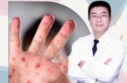 猴痘会成大规模传染病吗，猴痘是法定传染病吗