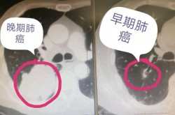 肺癌的早期症状及表现，肺癌最早期的症状