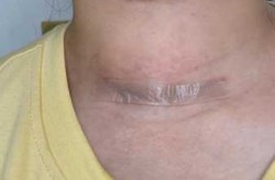 甲状腺结节多发需要治疗吗，什么叫多发性甲状腺结节严重吗