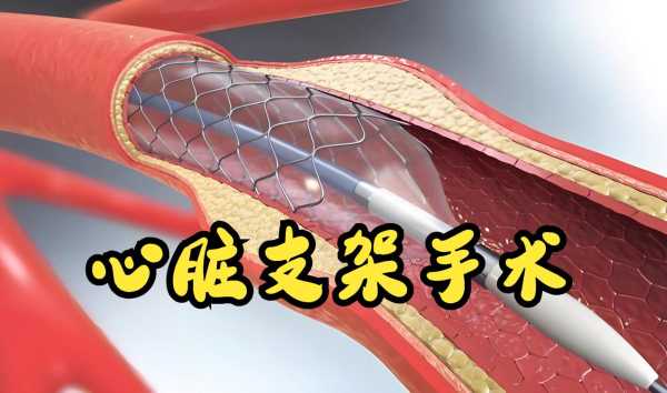 心脏支架从1.3万降至700元(2025年心脏支架新政策)