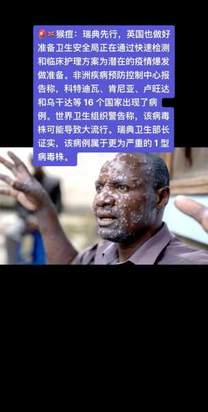 世卫:多国发现猴痘属非典型（猴痘中国有多少人感染了）