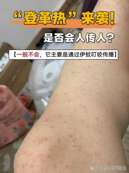 登革热会传染给家人吗,登革热能人传人吗