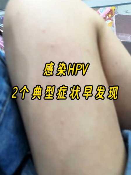 感染了阳性会有什么感觉，感染hpv有什么症状