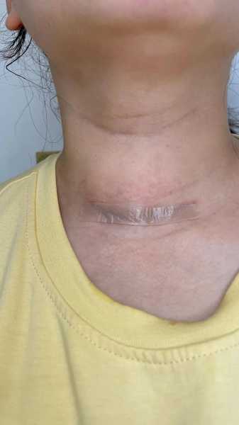 甲状腺结节多发需要治疗吗，什么叫多发性甲状腺结节严重吗