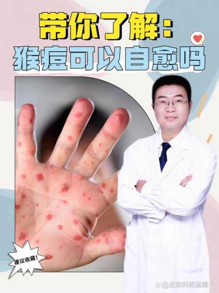 猴痘会成大规模传染病吗,猴痘是法定传染病吗