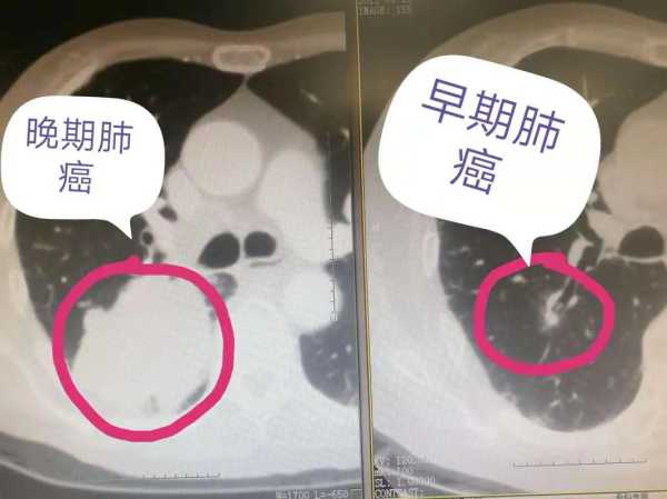 肺癌的早期症状及表现，肺癌最早期的症状